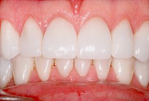 Everyday Dental | Periodontal Treatment, Preventative Program and Dental Bridges